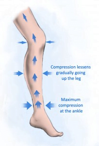 How Compression Hose Help Treat Vein Disorders