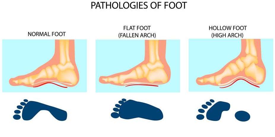 flat-feet-high-arched-feet-step-by-step-footcare